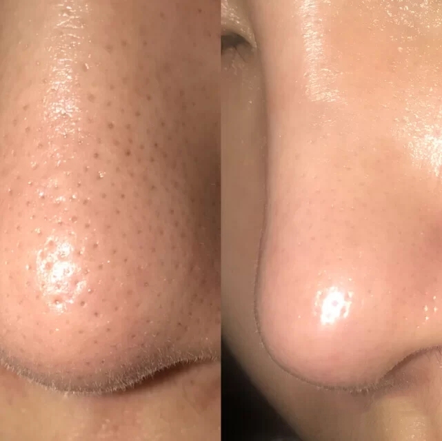 芭贝拉收缩毛孔鼻贴,黑头鼻贴收缩毛孔男