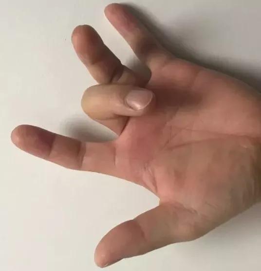 手指关节疼医生说没事是什么原因,有一个手指伸不开特别疼