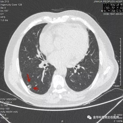 警惕-会是简单的肺大泡吗？