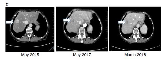 如何选择最好的靶向药？基因表达很重要