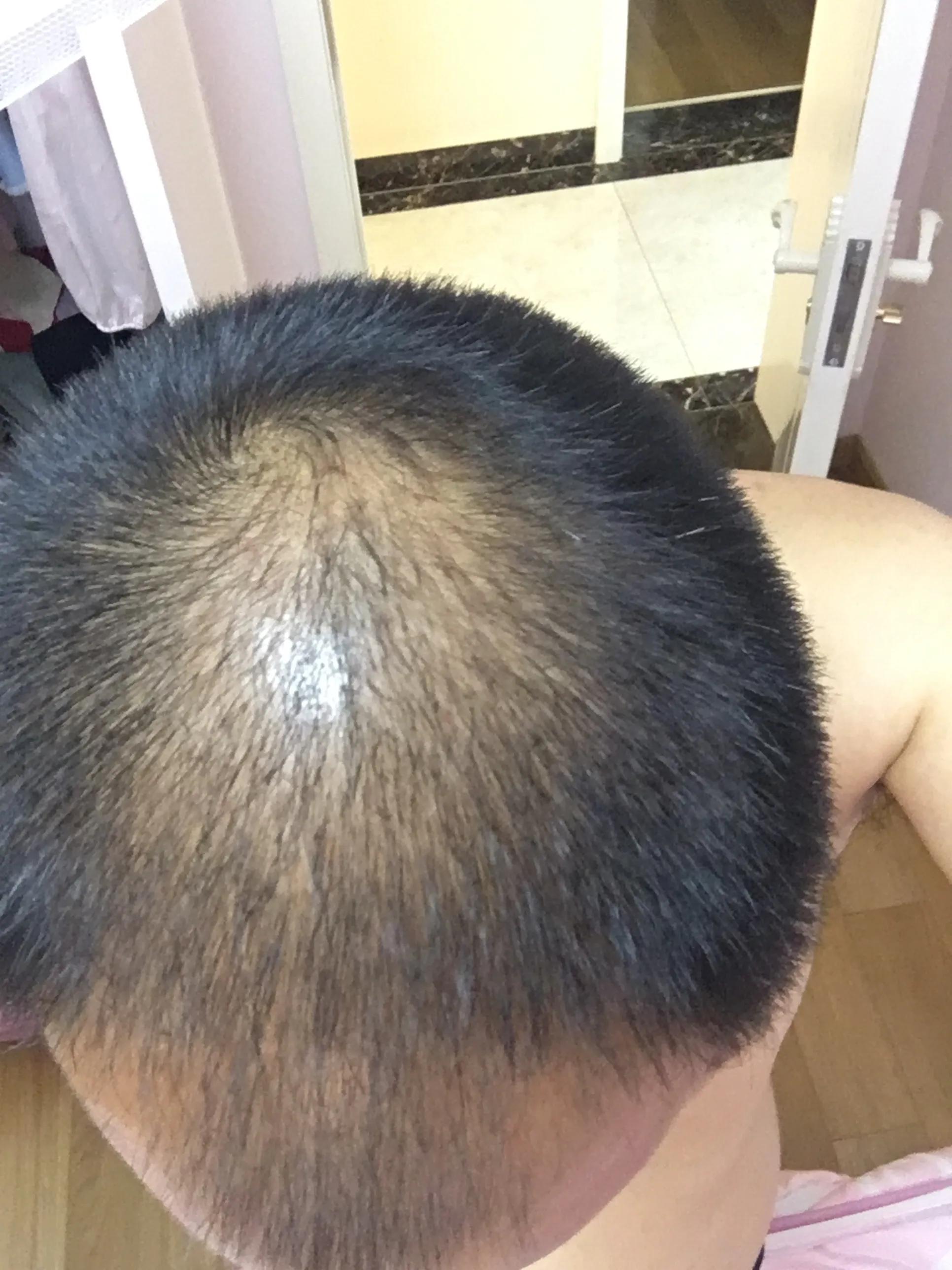 脂溢性脱发的治疗费用,脂溢性脱发的治疗方式