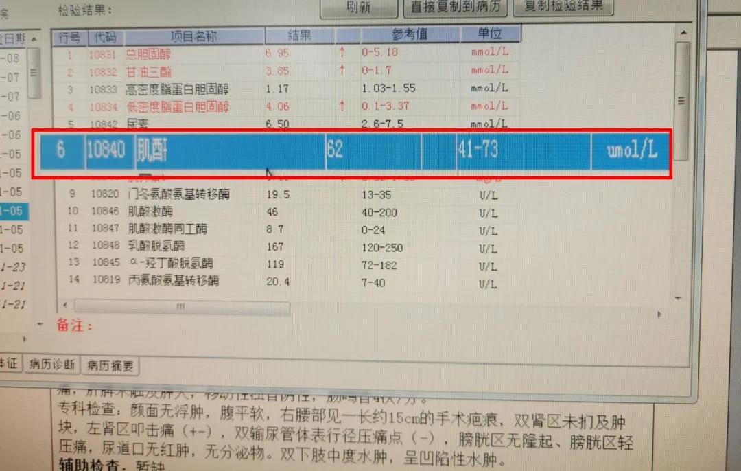 小结石3x3mm,3mm结石没感觉就出来了
