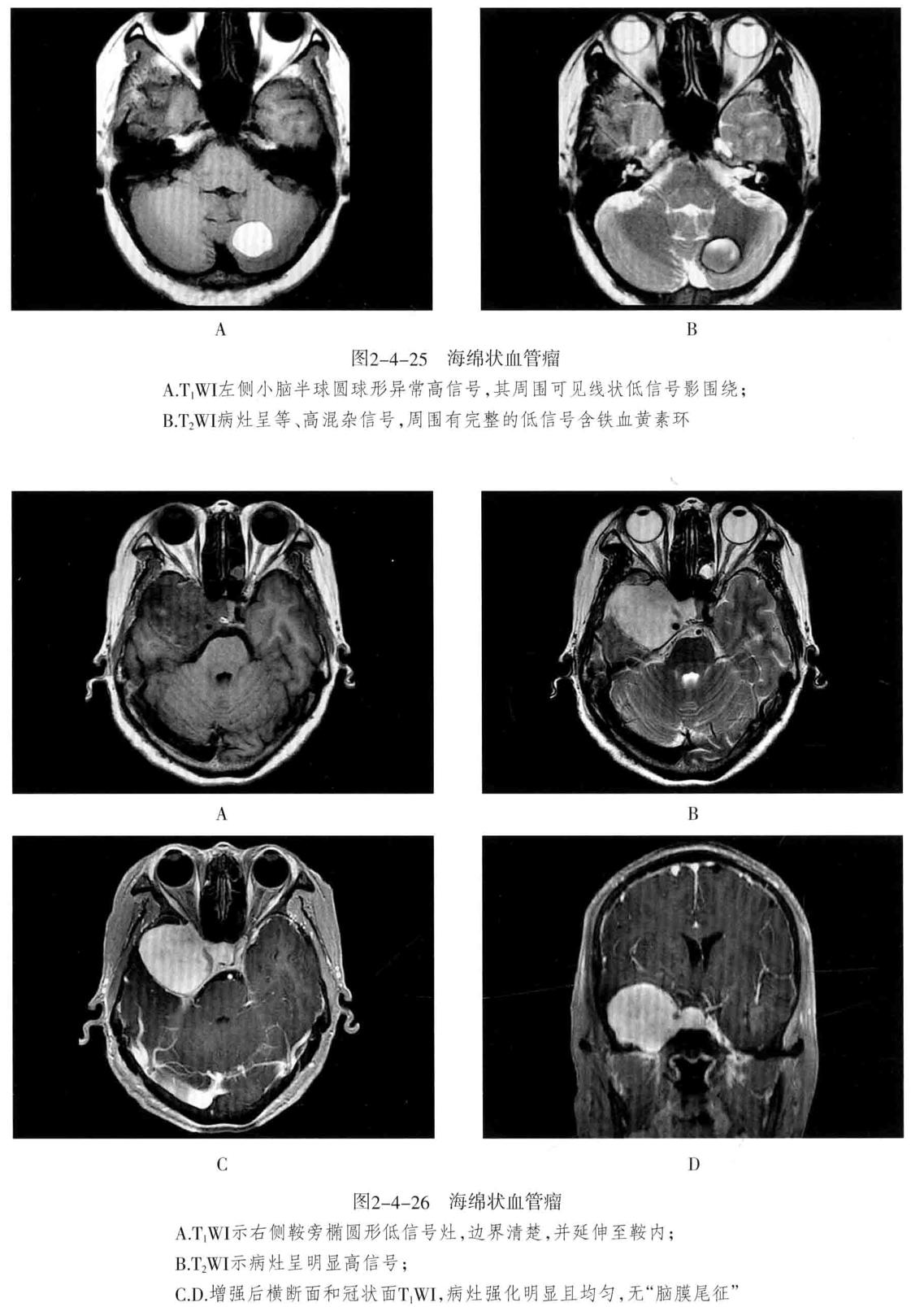 颅内血管周围间隙的影像鉴别,颅脑血管源性疾病影像诊断