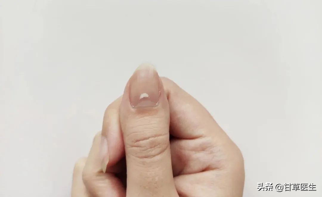 指甲出现这几种变化可能是肿瘤,心血管疾病指甲有变化吗