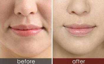 法令纹苹果肌下垂有什么办法改善,如何改善法令纹和苹果肌下垂