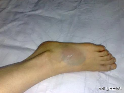 习惯性脚踝扭伤3年怎么治疗,习惯性扭伤脚踝隐隐作痛