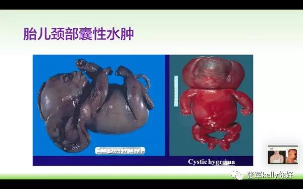 Turner综合征的指南学习