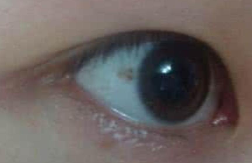 小孩眼白有黑点是啥原因,儿童眼白有黑点是怎么回事