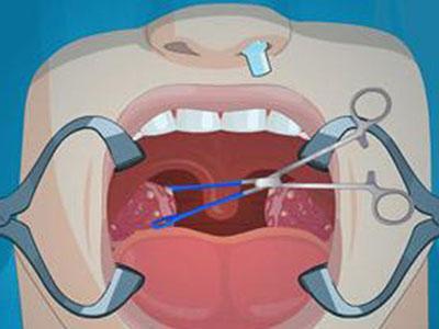 扁桃体发炎避免发烧,扁桃体反复发炎可以考虑摘除吗