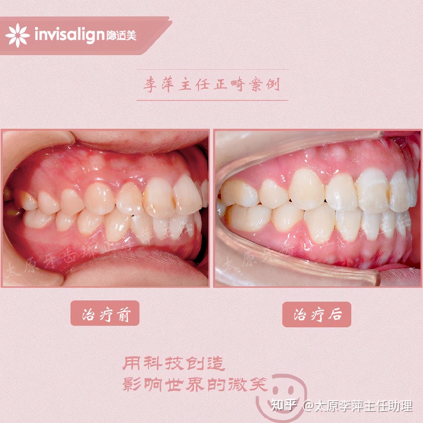 太原矫正牙齿需要做正颌吗,太原牙齿二次矫正