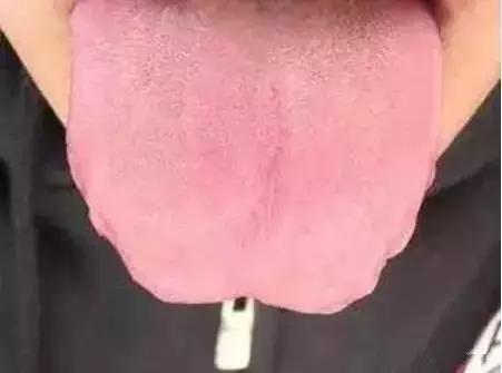 舌头一旦出现这个信号马上找中医,舌头一旦出现这个信号马上去医院