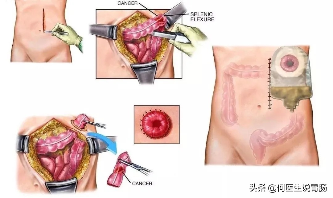 越来越多人因肠癌丧命,肛肠癌怎样缓解痛苦