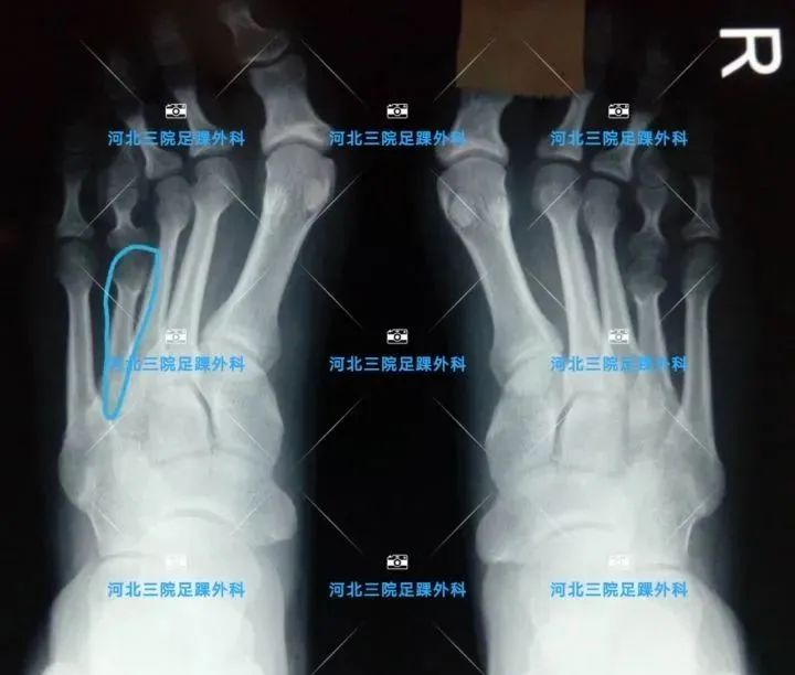 第四足趾短小怎么办,为什么第四脚趾短小