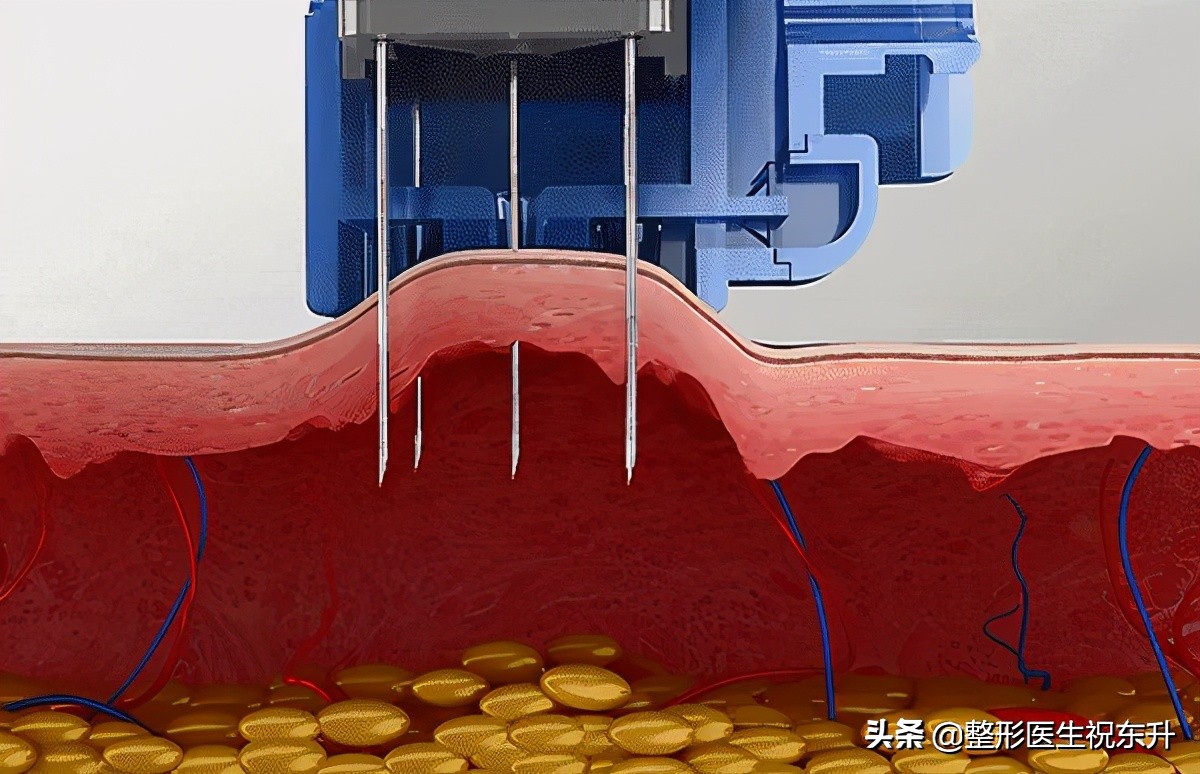 打完水光针皮肤特别油,韩国明星打完水光针的皮肤效果