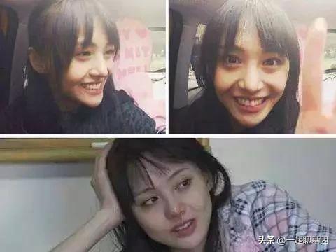 大眼袋眼纹抹平了,眼纹医美怎么去除