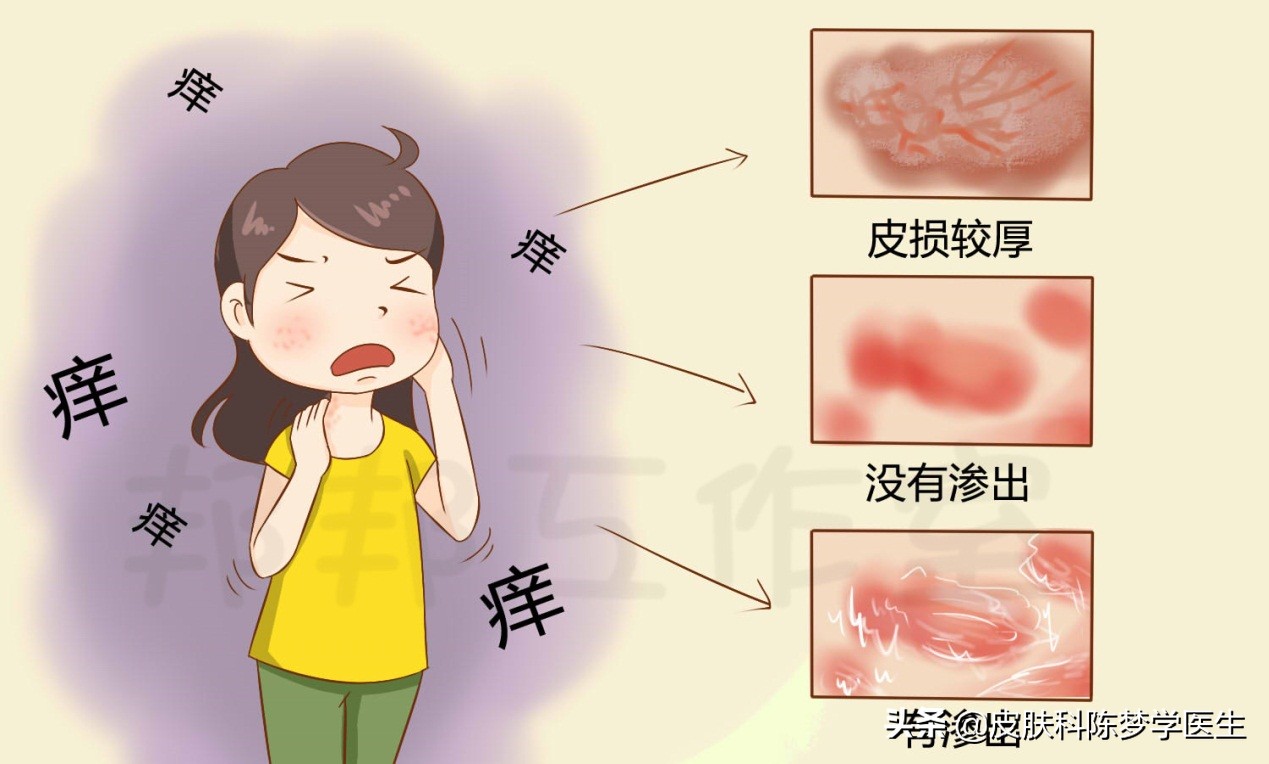 湿疹痒痒痒，该如何分期治疗？