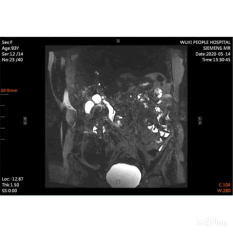 87岁老人医院取石,无锡保胆取石哪些医院最好