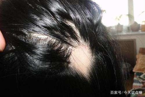 乡村灵异怪谈之治疗鬼剃头的林医生