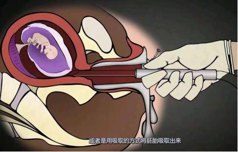 人工流产是怎样的过程现场实录,人工流产一个月手术记录全过程