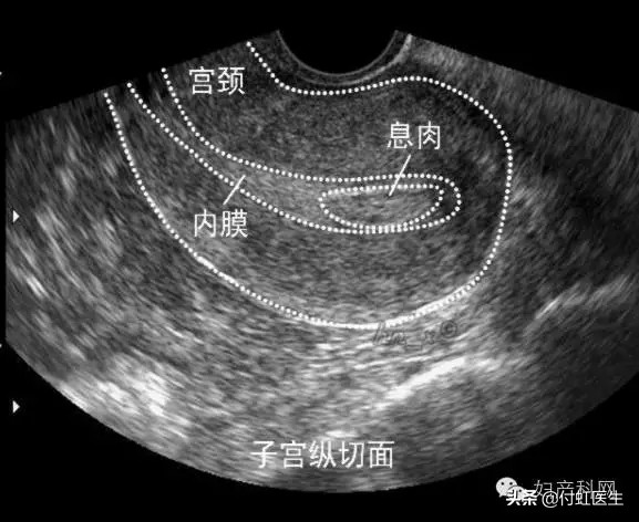 b超检查内膜回声不均是怎么回事,b超子宫内膜回声不均是怎么回事