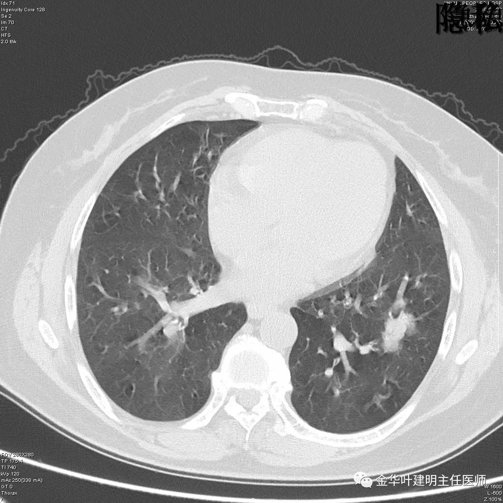 左肺下叶恶性病变,左肺上叶和下叶都有血管畸形