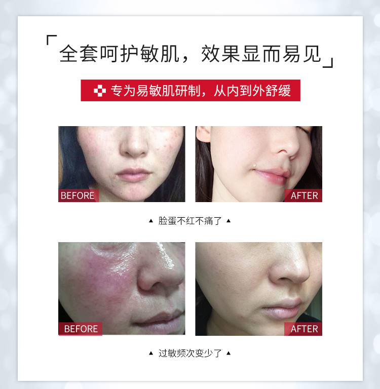 修复红血丝用什么方法最好,如何修复红血丝用什么护肤品