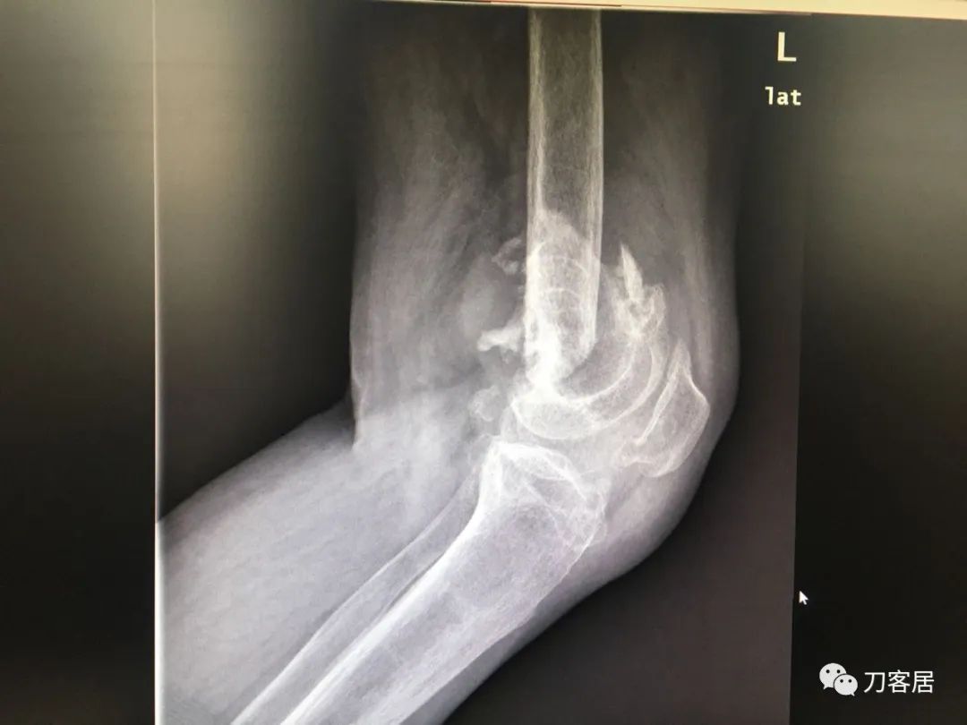 股骨胫骨骨折中医治疗方法,中药治疗股骨颈骨折