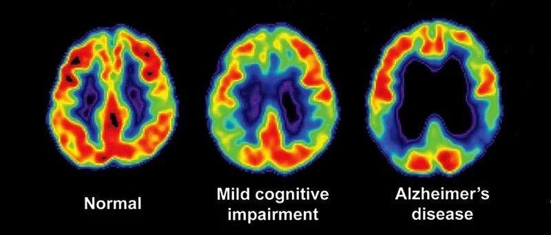 最新干细胞治疗脑卒中临床招募,上海干细胞治疗脑卒中临床