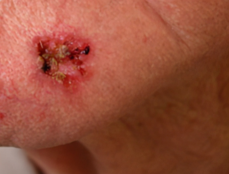 点痣会导致皮肤癌吗,点痣点出皮肤癌