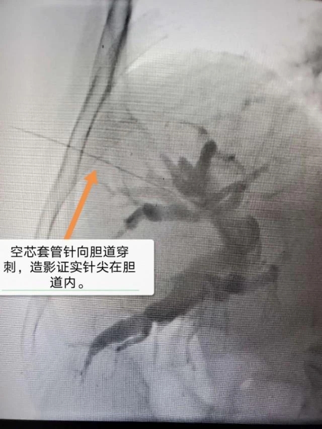 老年人夜间突发寒战高热呕吐,老人突发高热