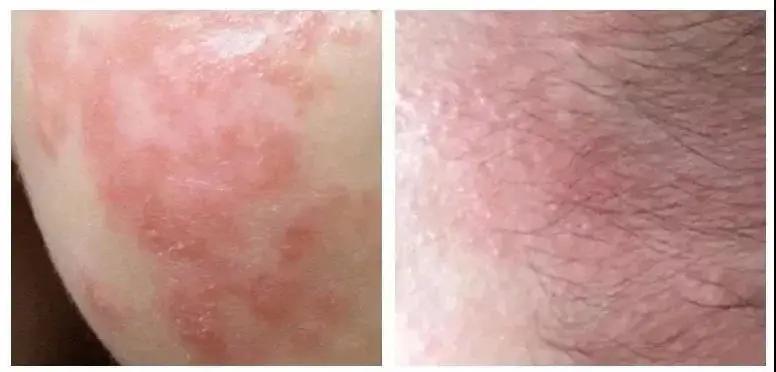 夏天脖子和脸上长痱子怎么办,痱子会长在脸上和脖子上吗