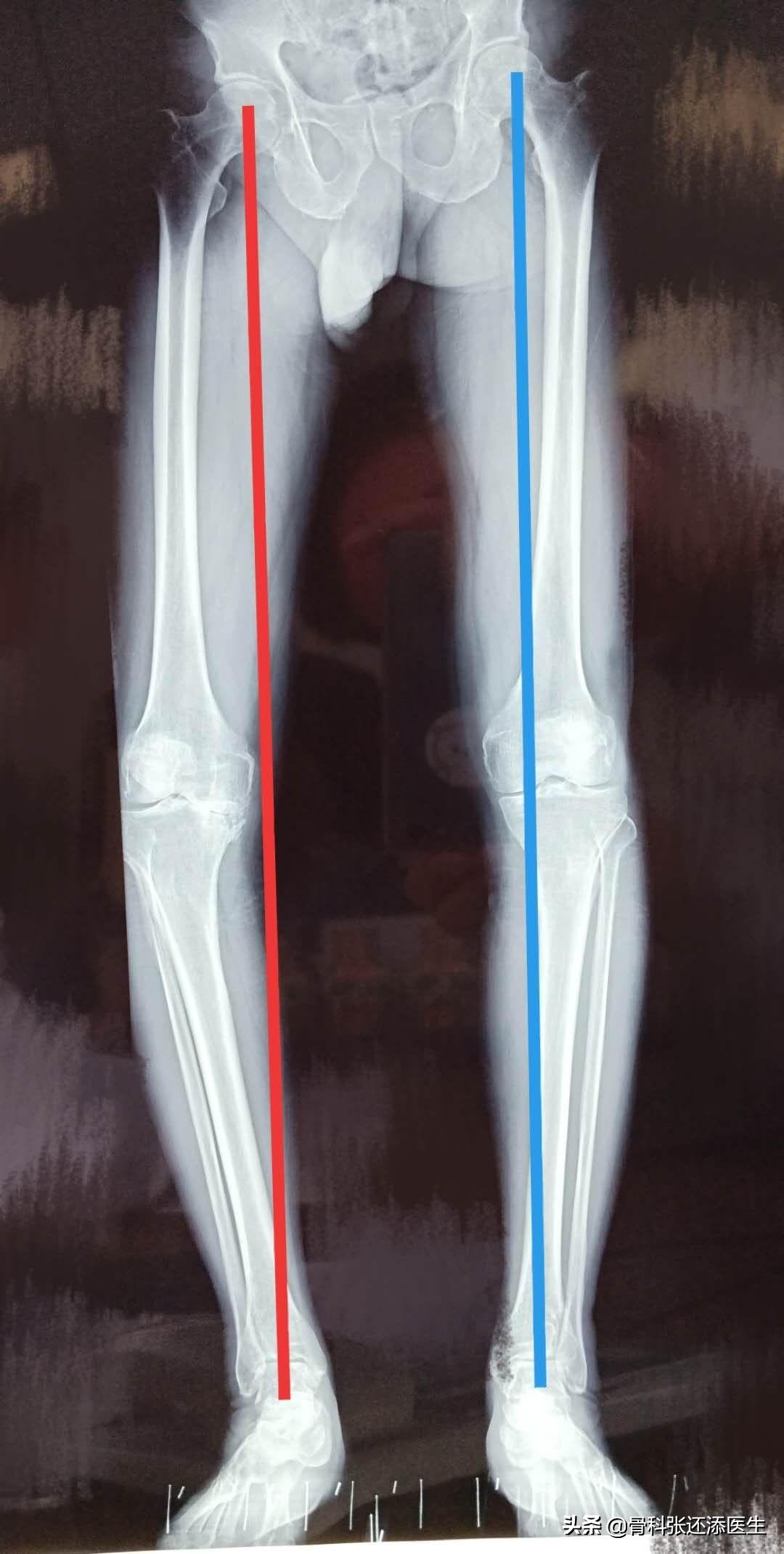 膝盖走路咯噔响还疼是什么原因,膝盖弯曲膝盖响是什么原因