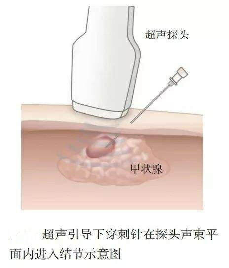 得了甲状腺结节怎样治疗最好,甲状腺结节4a为啥医生让立即手术