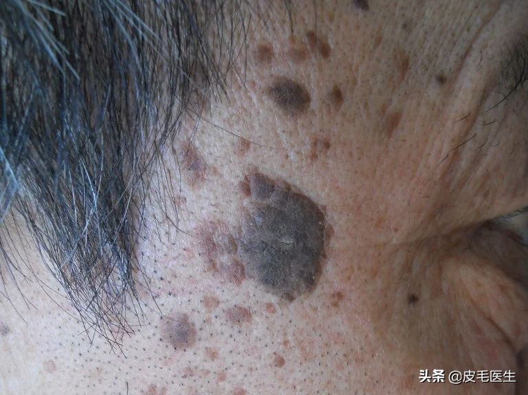 雀斑黄褐斑老年斑祛斑方法,褐斑老年斑怎么治疗效果最好