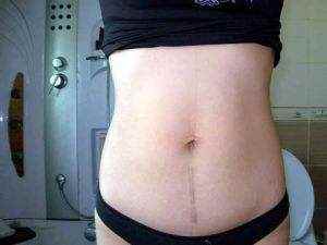 剖腹产产妇疤痕怎样修复,剖腹产疤痕对产妇有影响吗