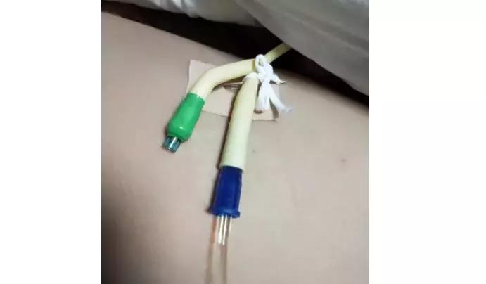 尿管固定别小看5cm，却是“血”的差距！