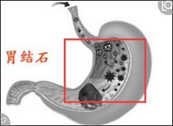 胃有结石,胃上有结石