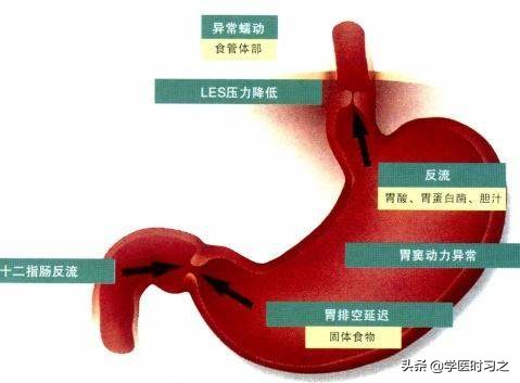 返流性食管炎常用药物治疗