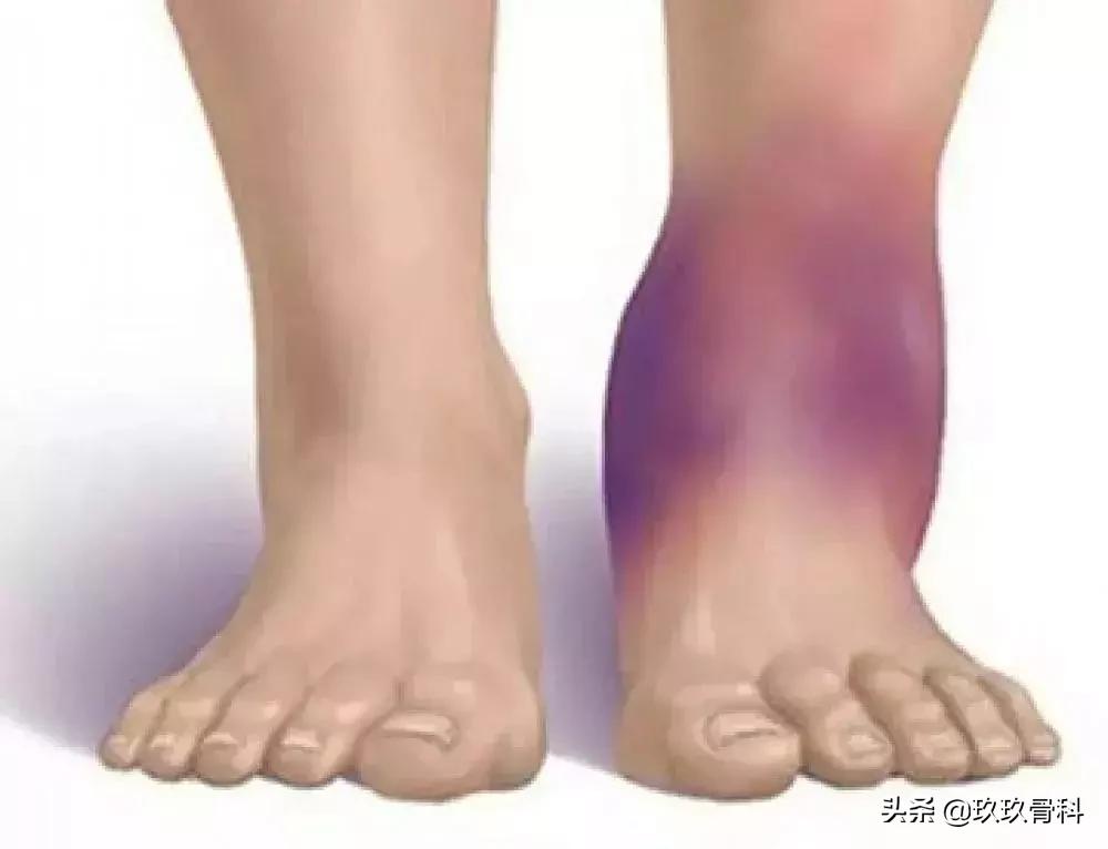 崴脚后遗症的三步恢复法,很多人的脚都崴伤