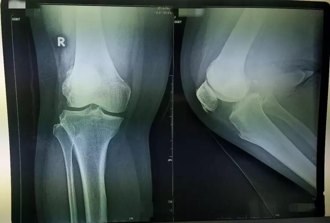 换膝盖关节手术有瘫痪风险吗,换膝手术可以百万医疗理赔吗