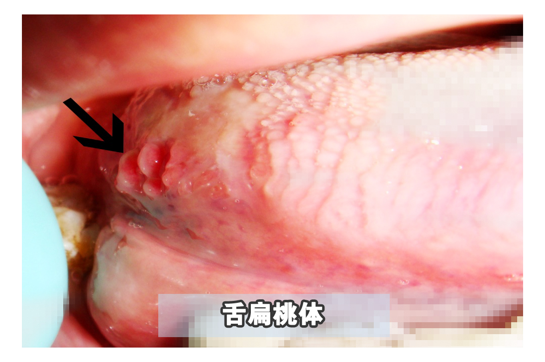 嘴里长了一个肉揪是怎么回事,嘴里长了肉疙瘩是癌症吗