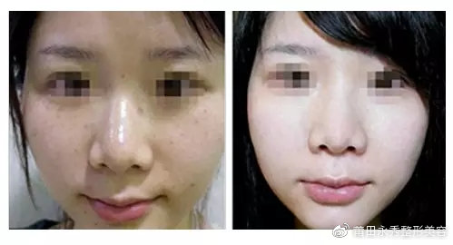 光子嫩肤疼不疼是电流开大了吗,光子嫩肤疼么要敷麻药吗