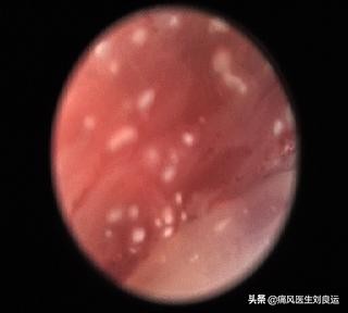 痛风降尿酸浑身痛,痛风降下来脚关节红肿痛