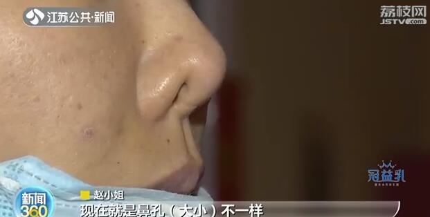 女子隆鼻拆夹板歪了,施尔美整形医院鼻综合