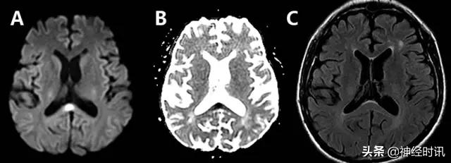 脑卒中的快速识别ppt,脑卒中神经影像学实例解析