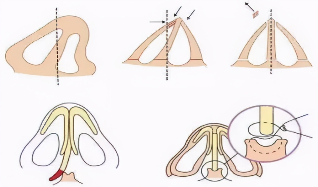鼻孔不对称最佳解决方法,鼻子一侧通气不流畅鼻孔不对称