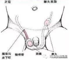 3岁男宝个头小,男婴儿出生只有一个蛋怎么办
