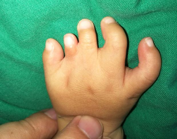 并指畸形免植皮案例,并指畸形