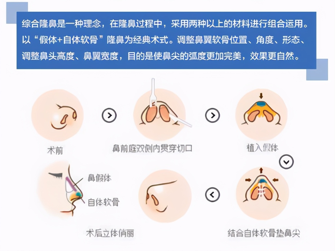 鼻部太瘦做鼻综合效果怎样,鼻尖塑形和鼻头缩小是一种手术吗
