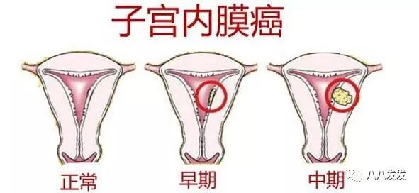 绝经后来月经是不是等走了再去查,绝经后来月经一定是癌吗